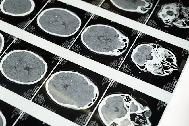 ¿Cuáles son los síntomas de la adicción a la tecnología?