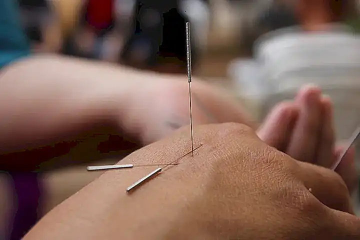 Factores a considerar al determinar el número de sesiones de acupuntura necesarias