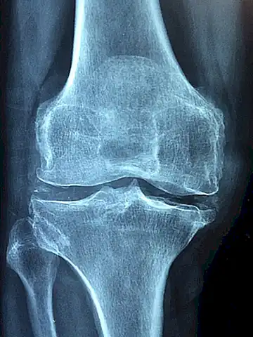 III. Tratamientos Ayurvédicos para dolores articulares y musculares