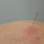 Los puntos de acupuntura clave para tratar el dolor: guía completa