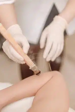Moxibustión