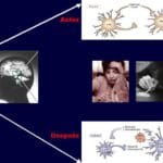 Neurobiología de la adicción: bases neuronales del trastorno