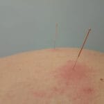 Puntos de acupuntura para aliviar dolor: Efectividad y aplicación