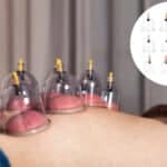 Revitaliza tu cuerpo con ventosas terapia: descubre sus beneficios