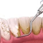 Tratamiento eficaz para caries y encías con homeopatía: mejora tu salud bucal